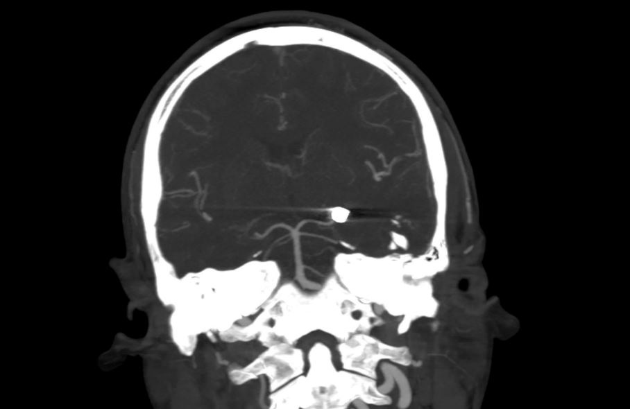 CT scan of pellet