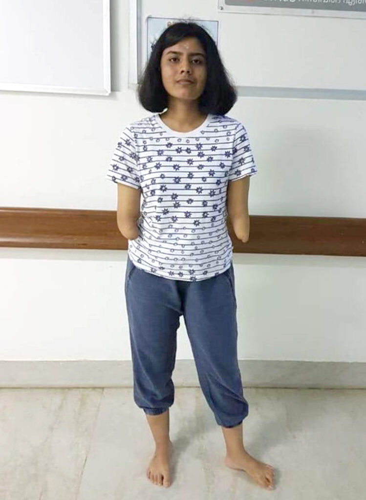 Shreya, a young woman with shoulder length dark hair, stands in a blue and white short sleeve shirt, and blue sweatpants, before surgery, her arms without hands.