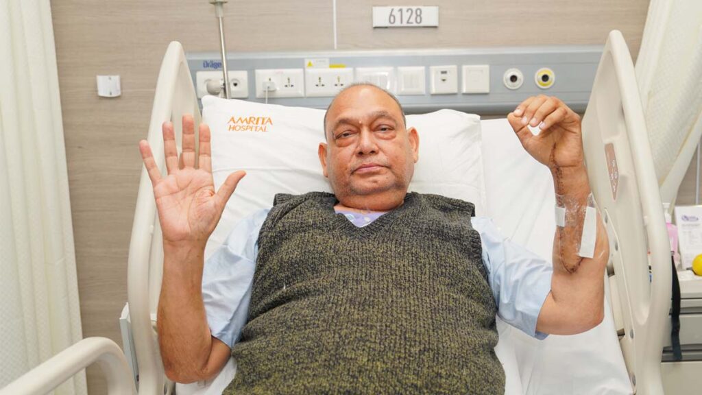 64 year old man shows hand transplantation