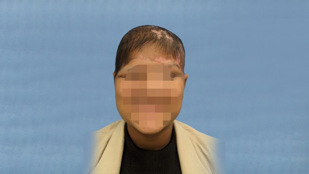 Woman facing front with new hair starting to grow back. Face blurred for privacy.